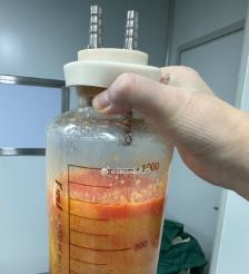 温岭水动力吸脂手术要做多久？